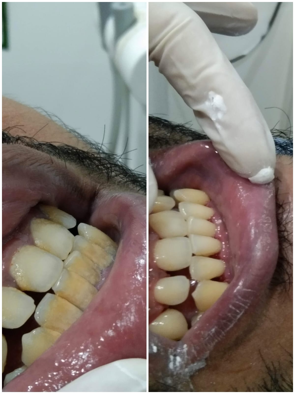 Understanding Laser Dentistry: Modern, Painless Dental Treatment